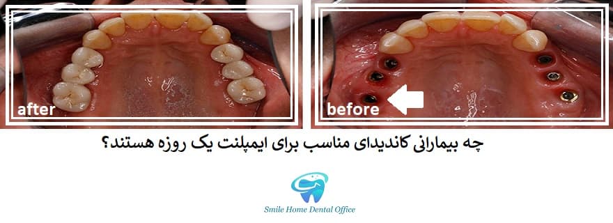 چه بیمارانی کاندیدای مناسب برای ایمپلنت یک روزه هستند؟