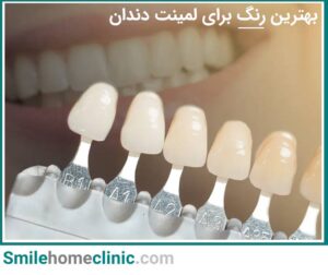بهترین رنگ برای لمینت دندان