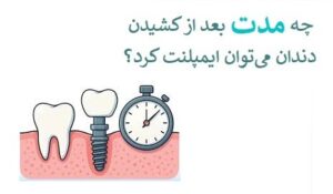 چه مدت بعد از کشیدن دندان بهترین زمان کاشت است؟
