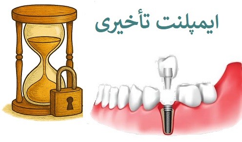 ایمپلنت تأخیری چیست و در چه شرایطی توصیه می‌شود؟