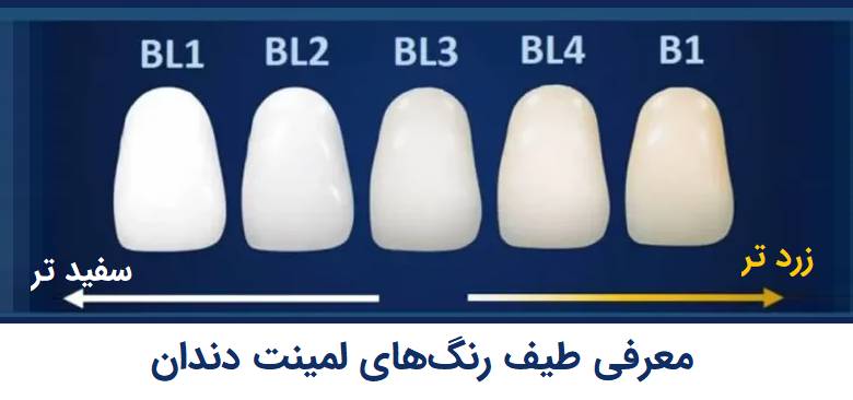 طیف های رنگی لمینت دندان 