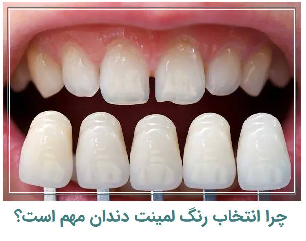 چرا رنگ لمینت دندان مهم است ؟ 