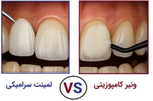 مقایسه ماندگاری لمینت و کامپوزیت مقایسه کامپوزیت و لمینت از نظر دوام و هزینه