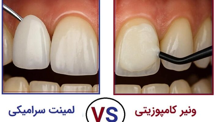 مقایسه ماندگاری لمینت و کامپوزیت مقایسه کامپوزیت و لمینت از نظر دوام و هزینه