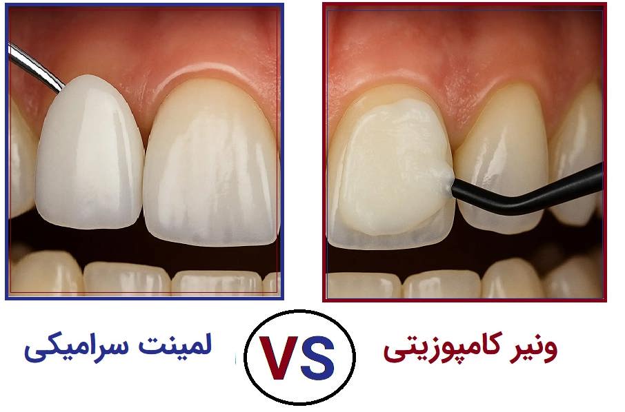 مقایسه ماندگاری لمینت و کامپوزیت مقایسه کامپوزیت و لمینت از نظر دوام و هزینه