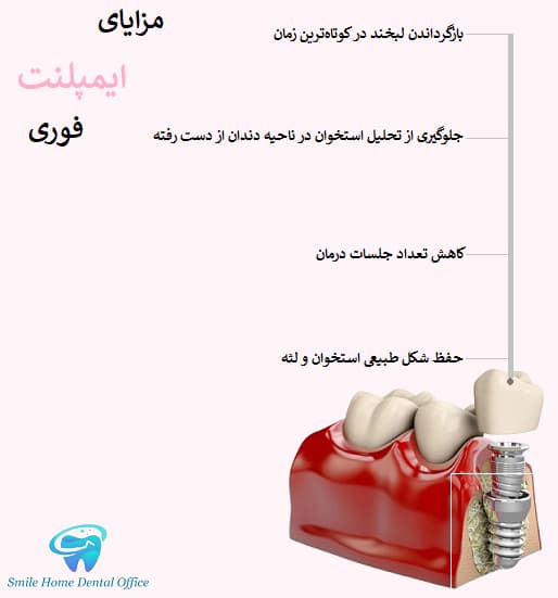 مزایای ایمپلنت فوری 