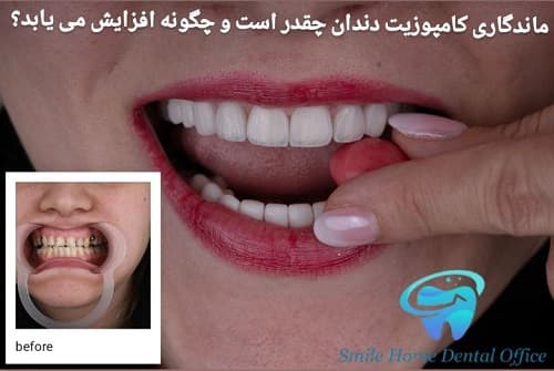 ماندگاری کامپوزیت دندان چقدر است و چگونه افزایش می‌یابد؟