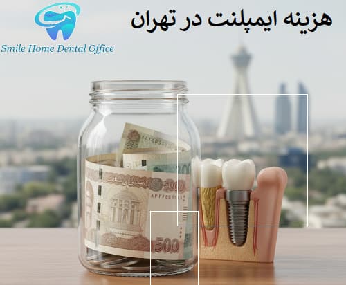 هزینه ایمپلنت در تهران