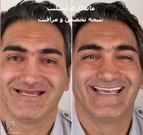 ماندگاری ایمپلنت؛ نتیجه تخصص و مراقبت