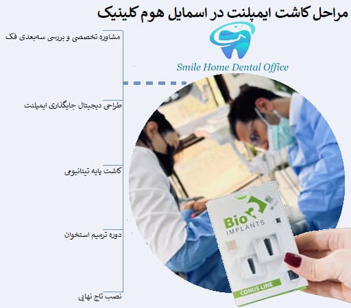 مراحل کاشت ایمپلنت در اسمایل هوم کلینیک