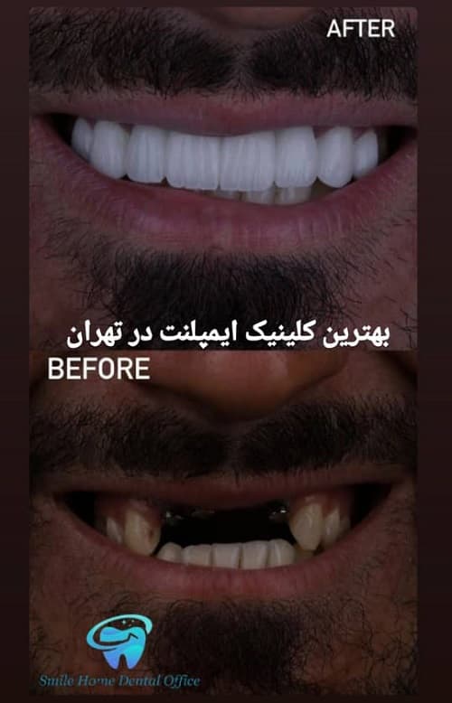 بهترین کلینیک ایمپلنت در تهران