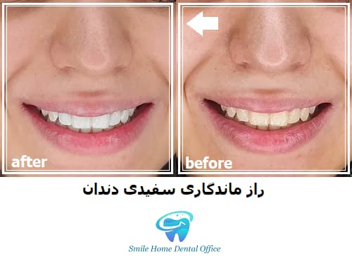 راز ماندگاری سفیدی دندان