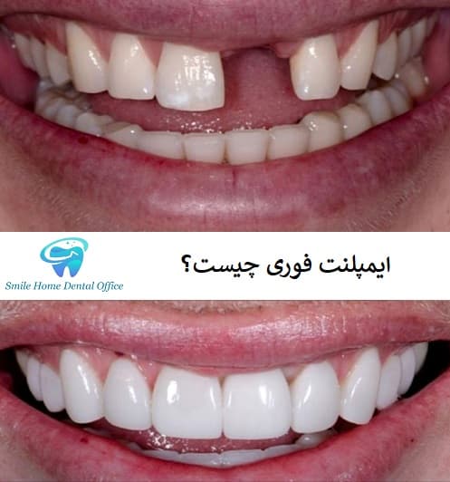 ایمپلنت فوری چیست و در چه شرایطی انجام می‌شود؟