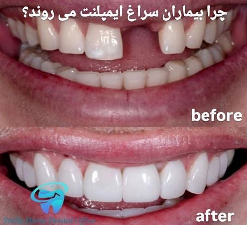 چرا بیماران سراغ ایمپلنت می‌روند؟