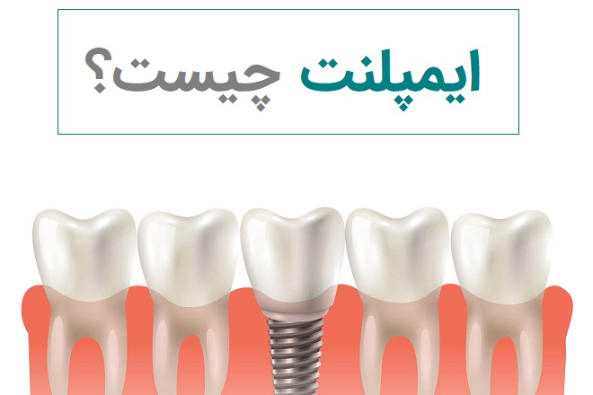 ایمپلنت دندان چیست و چرا باید در مرکز تخصصی انجام شود؟