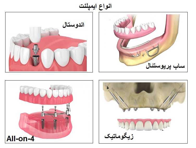 انواع ایمپلنت دندان