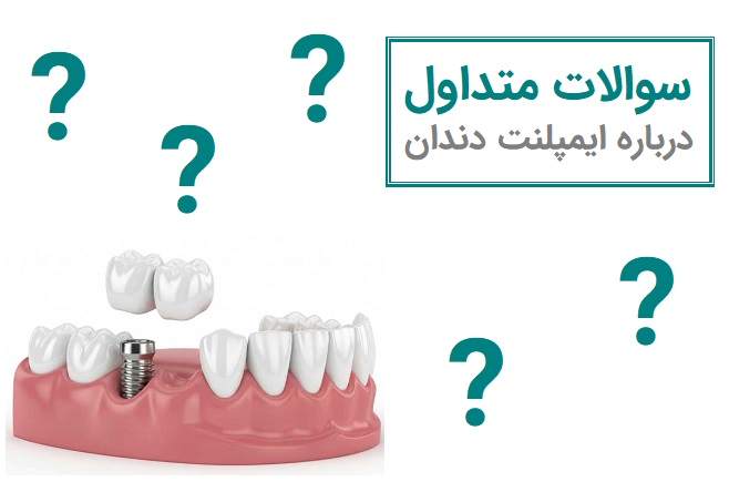 سوالات متداول درباره ایمپلنت دندان