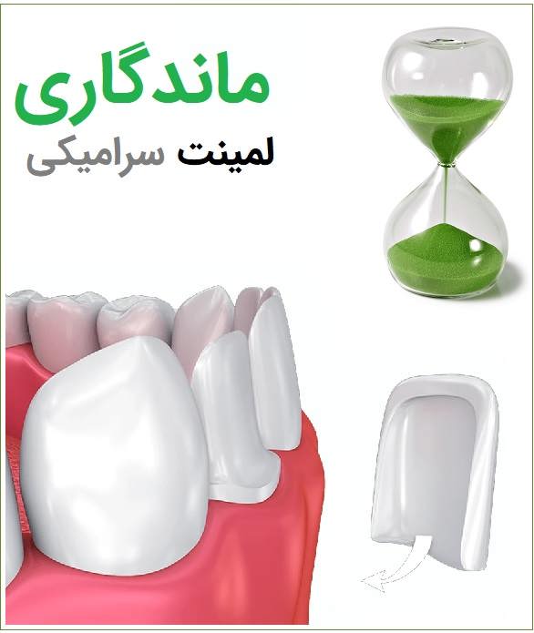 ماندگاری لمینت سرامیکی؛ زیبایی بادوام