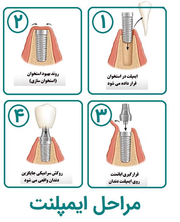 مراحل انجام ایمپلنت در مراکز تخصصی شمال تهران