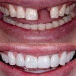 گالری عکس ایمپلنت