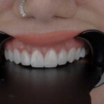 لمینت دندان