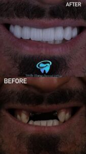 عکس قبل و بعد از ایمپلنت