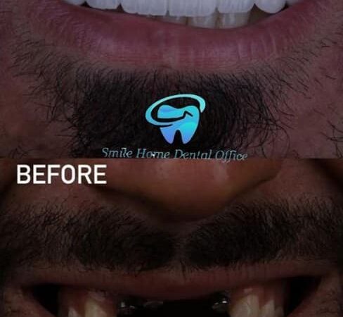 عکس قبل و بعد از ایمپلنت