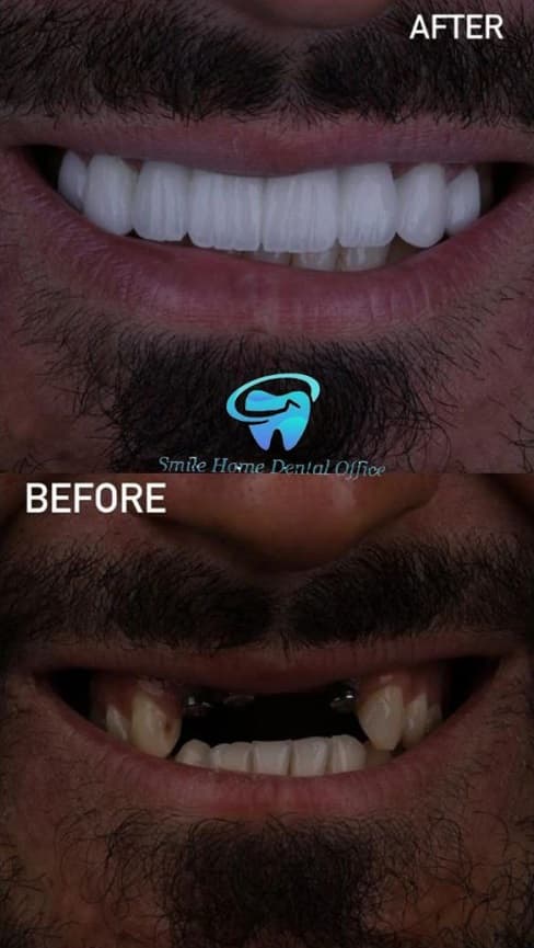 عکس قبل و بعد از ایمپلنت