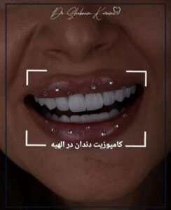 کامپوزیت دندان در الهیه