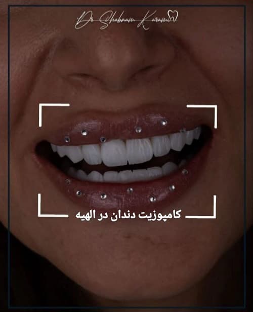 کامپوزیت دندان در الهیه