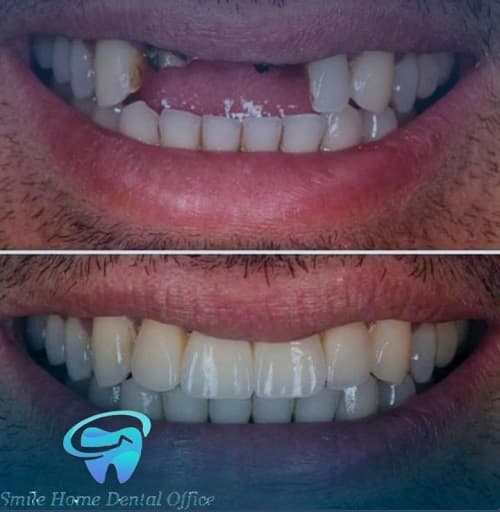 عکس ایمپلنت دیجیتال