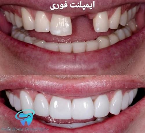 ایمپلنت فوری