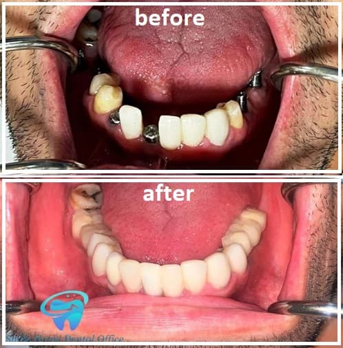 عکس ایمپلنت فک پایین