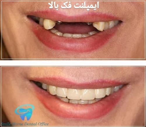 عکس ایمپلنت فک بالا