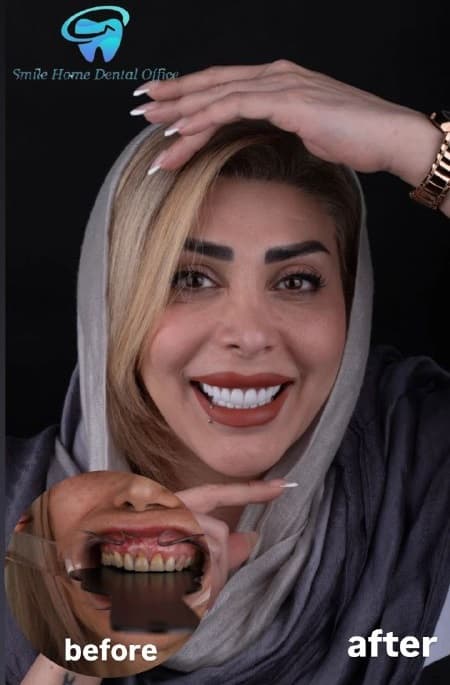 تفاوت لمینت سرامیکی و کامپوزیتی