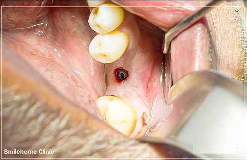 ایمپلنت بدون جراحی عکس