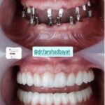 عکس ایمپلنت All-on-4 یا ایمپلنت کامل فک