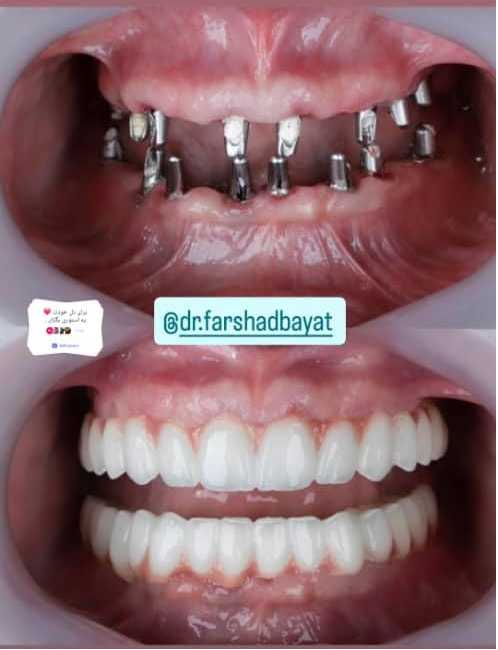 عکس ایمپلنت All-on-4 یا ایمپلنت کامل فک