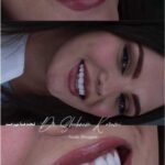 عکس لمینت دندان