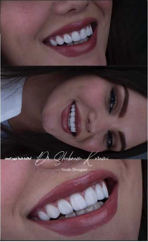 عکس لمینت دندان