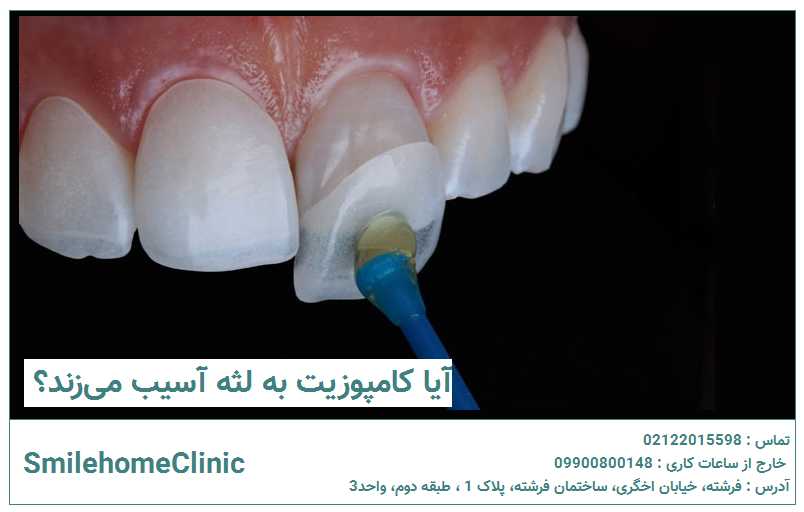 آیا کامپوزیت به لثه آسیب می‌زند؟