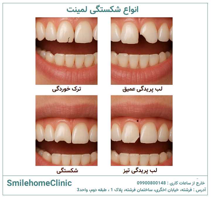 انواع شکستگی لمینت و کامپوزیت