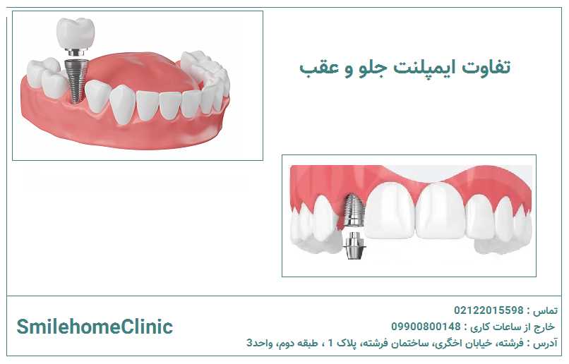 ایمپلنت دندان جلو چه تفاوتی با دندانهای عقب دارد؟