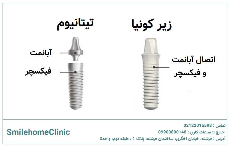 بهترین جنس ایمپلنت برای دندان جلو چیست؟