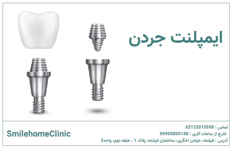 متخصص ایمپلنت در جردن