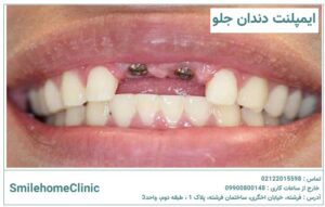 ایمپلنت دندان جلو