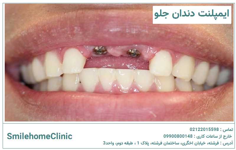 ایمپلنت دندان جلو