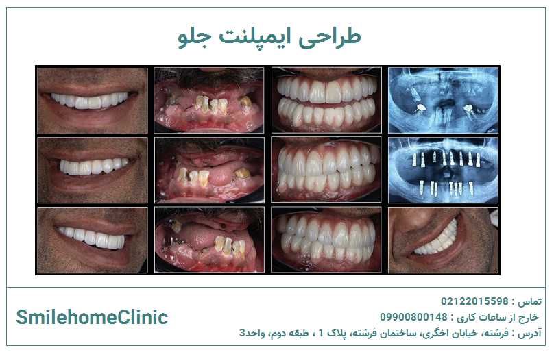 طراحی ایمپلنت در دندان جلو چقدر مهم است؟