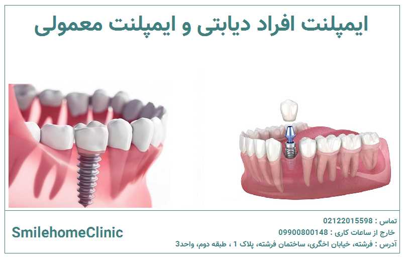 تفاوت ایمپلنت بیماران دیابتی با افراد سالم چیست؟