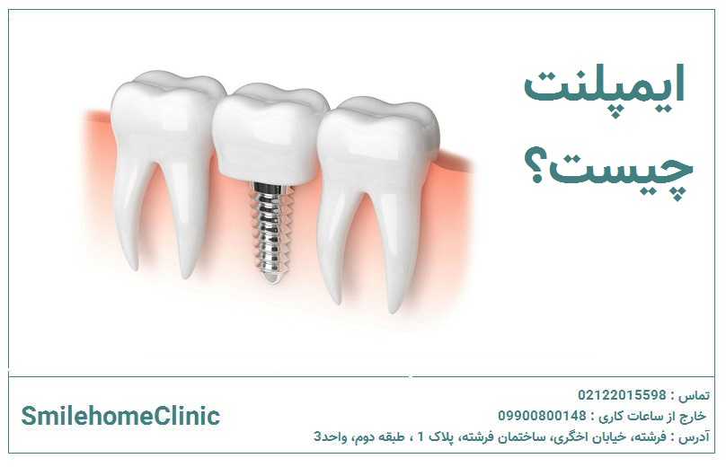 ایمپلنت چیست